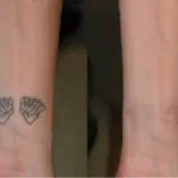 حذف تاتو و خالکوبی با لیزر کیوسوئیچ