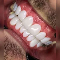 جشنواره پاییزه کامپوزیت لمینیت روکش طلا عصب کشی|خدمات آرایشگری و زیبایی|تهران, هفت حوض|دیوار
