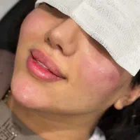 جشنواره ژل لب گونه چونه زاویه فک فیلرزیرچشم بوتاکس|خدمات آرایشگری و زیبایی|تهران, قلهک|دیوار