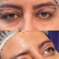 لیپو۴۵میلیون ابدو۶۵م باشرایط اقساط ساکشن غبغب۹۸۰۰|خدمات زیبایی و سلامت|تهران, قلهک|دیوار