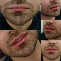 جشنواره پاییزه تزریق ژل و بوتاکس|خدمات آرایشگری و زیبایی|اصفهان, رزمندگان|دیوار