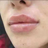 نیازمند مدل جهت تزریق فیلر