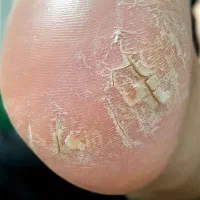 پدیکور مدیکال به صورت جامع