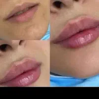 تزریق فیلر ، بوتاکس ، لیفت با نخ