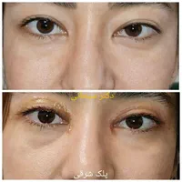 بلفاروپلاستی جراحی پلک لیفت شقیقه ابرو صورت بوتاکس|خدمات آرایشگری و زیبایی|تهران, سلسبیل جنوبی|دیوار