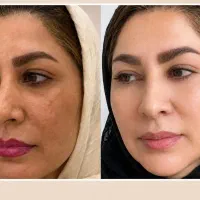تنها نمایندگی بیوممتیک بوتاکس لک ضدجوش ضدریزش