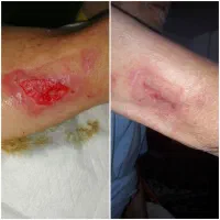 کارشناس تخصصی زخم و استوما|خدمات آرایشگری و زیبایی|قم, زنبیل آباد|دیوار