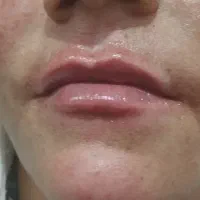 ژل سی سی 550  فیلر لب و گونه چانه و بوتاکس650|خدمات آرایشگری و زیبایی|قم, شهرک توانیر|دیوار