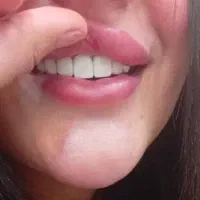 تخفیف ویژه پاییزه کامپوزیت دندان در درمانگاه