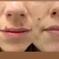 پاکننده زگیل و منگوله