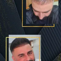 کاشت مو با تراکم بالا با تخفیف