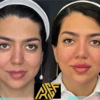 نخ لیفت صورت و غبغب با پزشک اقساطی