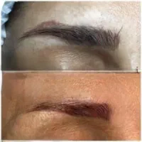 ریموو تتو صورت