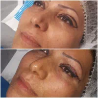 جراحی پلک (بلفاروپلاستی) توسط متخصص جراحی زیبایی