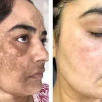 مشکلات پوستیت و درمان کن،نیازمند مدل بدون عکاسی