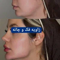 پکیج طلایی نقره ایی برنز لیفت با فیلر ژل بوتاکس|خدمات آرایشگری و زیبایی|مشهد, سناباد|دیوار