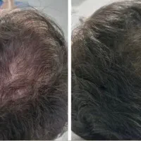 توقف ریزش مو و افزایش رویش مو