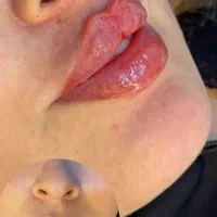 تخفیفات تزریق ژل و بوتاکس