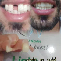 دندان متحرک مصنوعی بجای ایمپلنت فوری و سریع|آرایشی، بهداشتی، درمانی|رشت, گلسار|دیوار