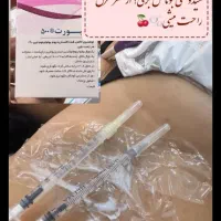 مدل ژل وبوتاکس|خدمات آرایشگری و زیبایی|اهواز, فاز ۲ پادادشهر|دیوار