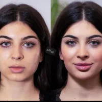 ساکشن شکمپهلوغبغب اندولیفت بلفارو