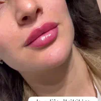 تخفیف تزریق ژل وبوتاکس