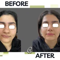 جراحی بینی رینوپلاستی تیپ پلاستی متخصص گوش حلق بین