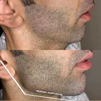 جشنواره تزریق ژل و بوتاکس|خدمات آرایشگری و زیبایی|اصفهان, دانشگاه اصفهان|دیوار