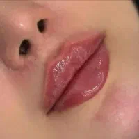 آموزش و تزریق فیلر و بوتاکس