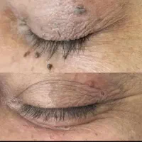 خالبرداری۲۰ت زگیل،بخیه،ختنه.جراحی شقیقه.ژل۳۹۰