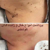 پاکسازی و‌رفع جای جوش و‌کک و مک off