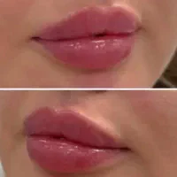 جشنواره ویژه فیلر لب فول فیس زاویه فک،گونه،چونه و.|خدمات آرایشگری و زیبایی|مشهد, شهید فرامرز عباسی|دیوار