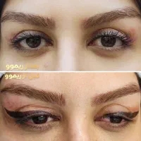 پاک کردن تتو(ریموو)