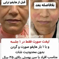 هایفو۷و۱۲بعد/حجم‌سینه‌باسن/پی‌آر‌پی/لیزرموهای زائد