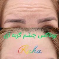 ژل/بوتاکس/آنزیم/مزو فقط ۳۰۰|خدمات آرایشگری و زیبایی|کرج, گوهردشت|دیوار