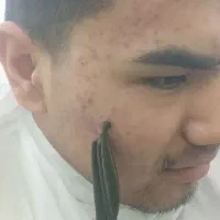 حجامت.زالو درمانی. فصدخون.طب سوزنی