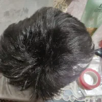 پروتز مو مردانه