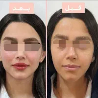 تزریق چربی ژل بوتاکس|خدمات آرایشگری و زیبایی|خرم‌آباد, |دیوار