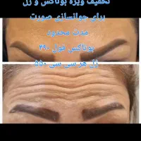 بمب تخفیف ژل و بوتاکس|خدمات آرایشگری و زیبایی|بندر امام خمینی, |دیوار