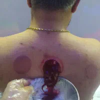 حجامت درمانی فیزیوتراپی وروغن و بادکش ورزشی|خدمات آرایشگری و زیبایی|اندیمشک, |دیوار