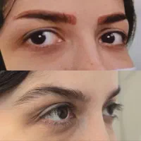 پاک کردن تتو ابرو/تتو بدن و خالکوبی/لیزر کیوسوییچ