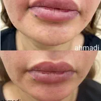 فیلر و بوتاکس