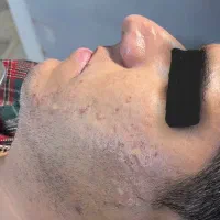 کلینیک تخصصی ترمیم جای جوش و زخم توسط پزشک