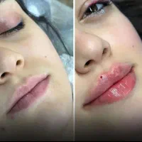 آف ویژه عیدانه تزریق انواع ژل، فیلر با تخفیف عالی