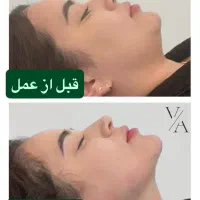 جشنواره تخفیفی لیپوماتیک بلفاروپلاستی و لیپوبازو|خدمات آرایشگری و زیبایی|تهران, ونک|دیوار