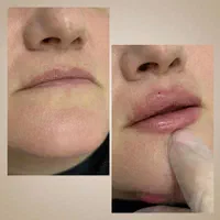 جشنواره تزریق فیلر در کلینیک پزشک|خدمات آرایشگری و زیبایی|شیراز, قدوسی غربی|دیوار