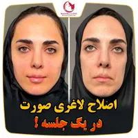 فرمدهی صورت بینی بدون جراحی بیهوشی پکیج یانگ فیس|خدمات آرایشگری و زیبایی|مشهد, هفت تیر (حافظ)|دیوار