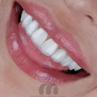 عصبکشی بدون درد/ دندانپزشکی VIP