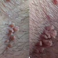 درمان محرمانه و ریشه ای HPV و HSV (تبخال و زگیل)