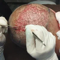 کاشت مو و ابرو|خدمات آرایشگری و زیبایی|سراب, |دیوار